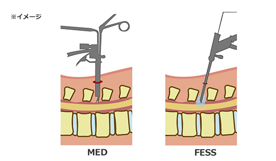 MED,FESSイメージ画像